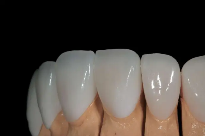 Finished denture crafted in AVF Dental Lab
