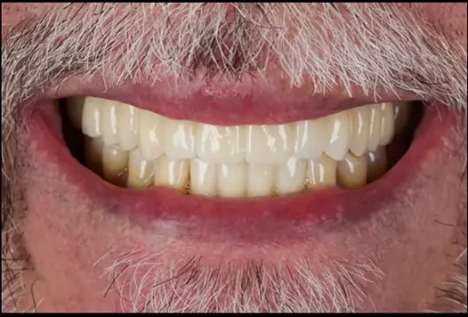 Cosmetic Smile Overlay — after