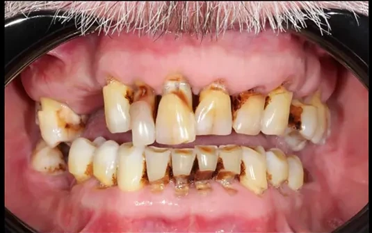 Cosmetic Smile Overlay — before