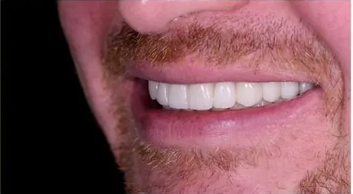 Full Mouth Functional Reconstruction — after