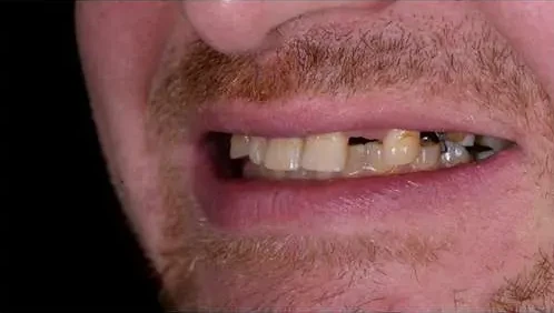 Full Mouth Functional Reconstruction — before