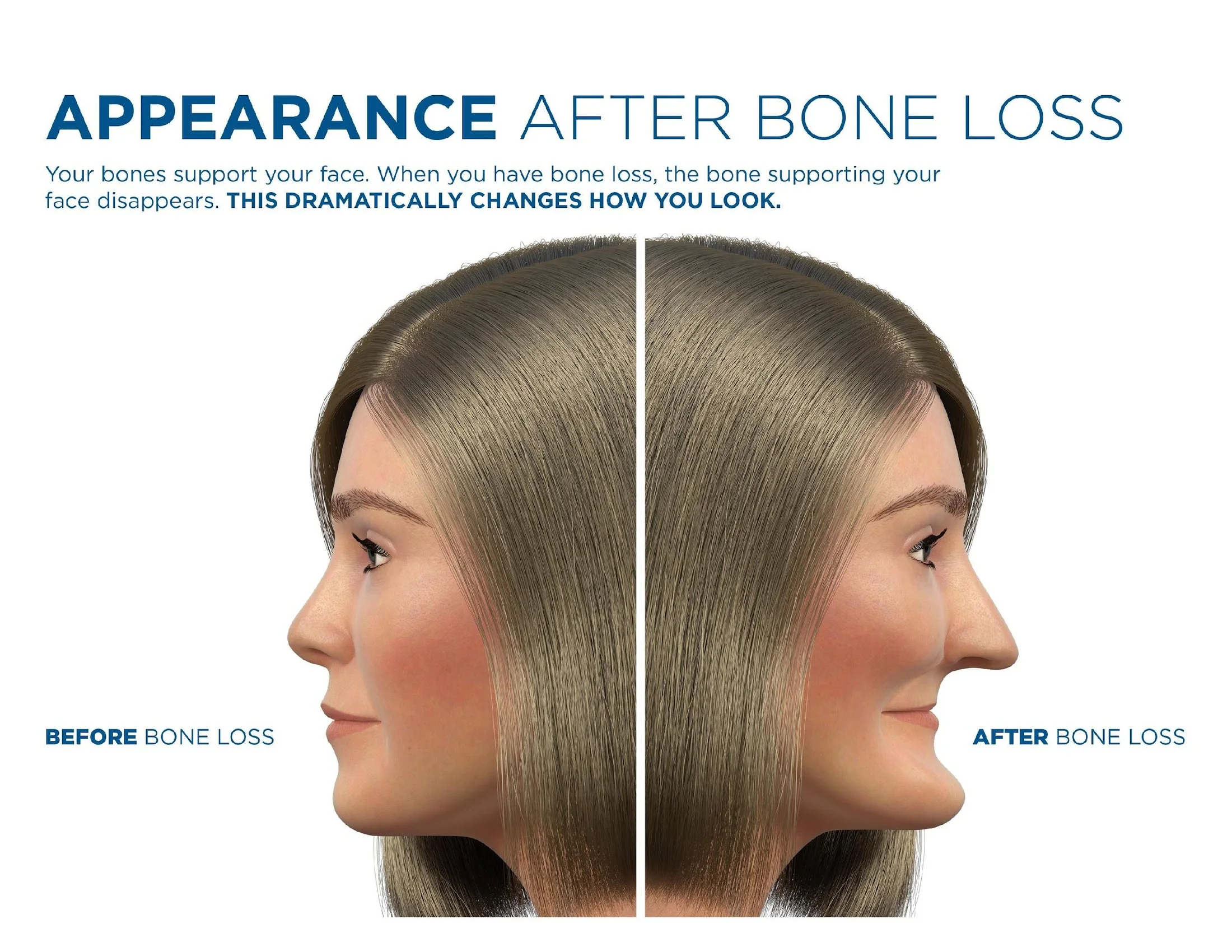 Facial profile comparison showing before and after bone loss from missing teeth