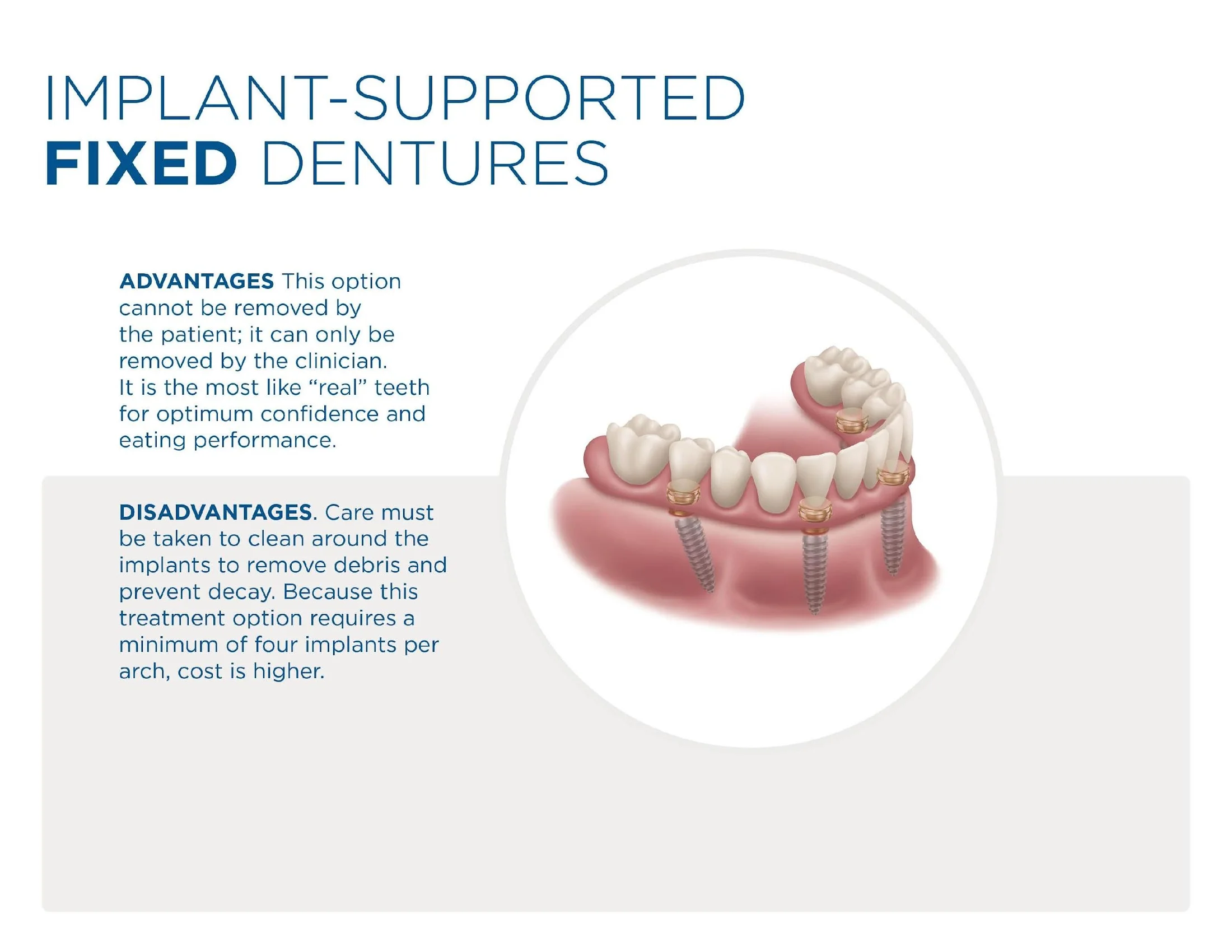 LOCATOR FIXED dental arch showing four implants supporting a permanent fixed denture