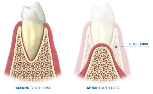 Jaw bone resorption after tooth loss