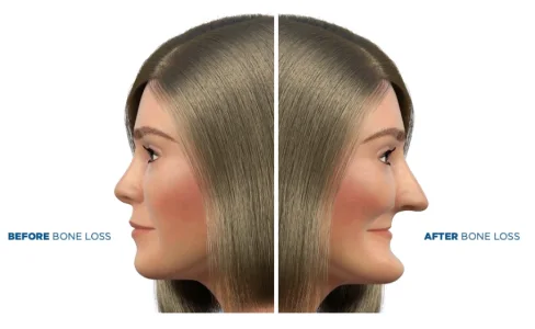 How bone loss changes facial appearance over time